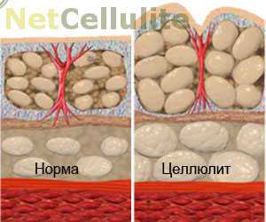 Типы целлюлита с фото